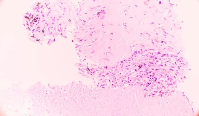 Microscopic view of a pulmonary nodule showing a necrotizing granuloma, a common finding in human heartworm cases.