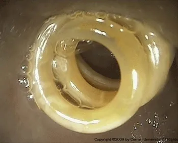 Visual representation of Ascarid roundworms visible within a dog's intestine, illustrating a heavy infection.