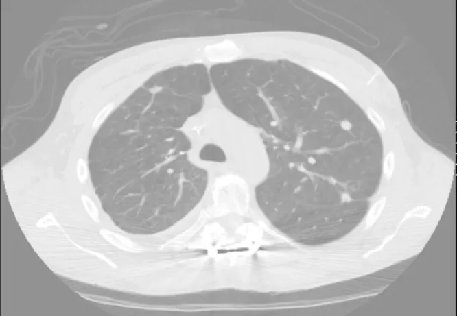 CT scan showing multiple pulmonary nodules in a human case linked to canine heartworm exposure