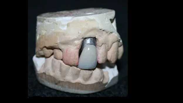 Elvis Presley dental crown in a collector's display