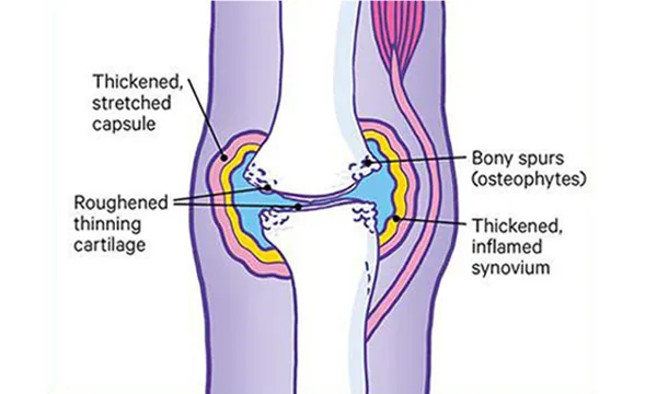 A joint affected by osteoarthritis