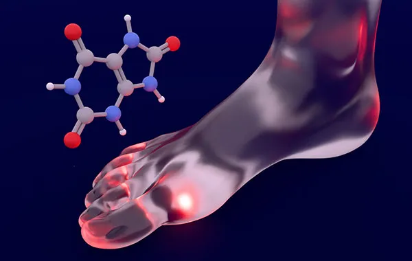 Gout in the foot