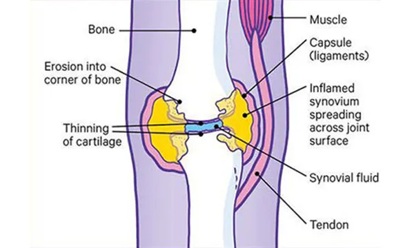 Joint affected by rheumatoid arthritis
