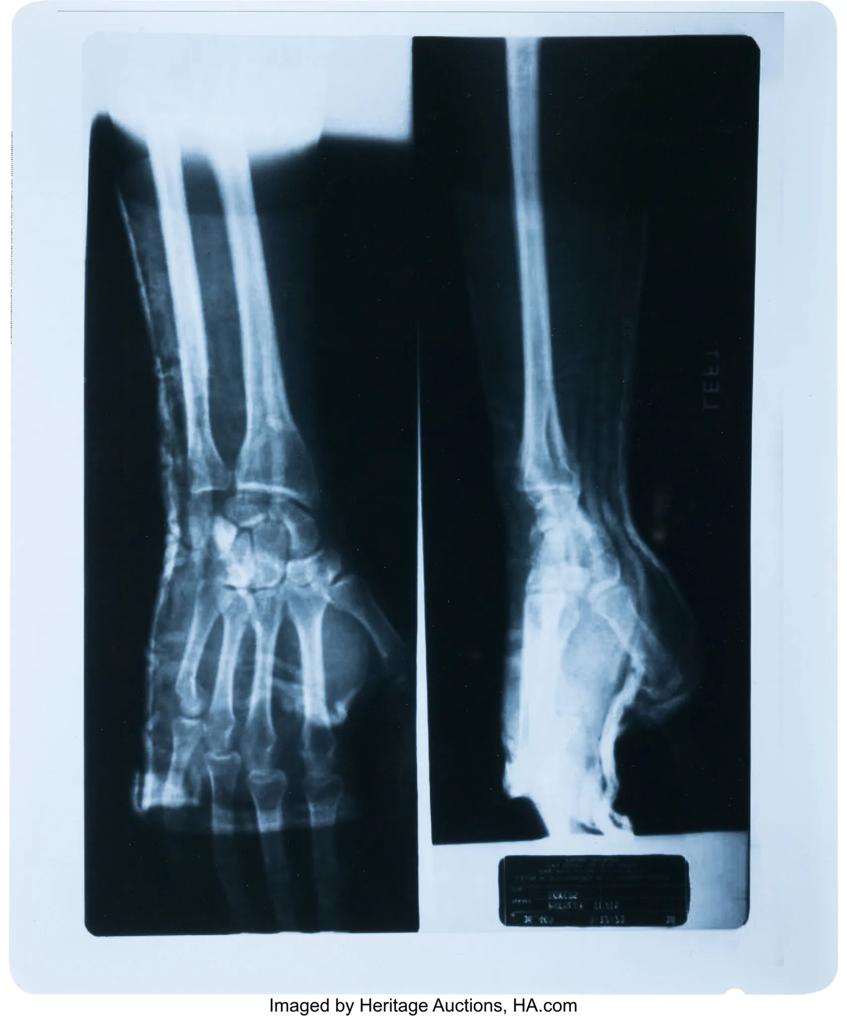 X-ray of Elvis Presley's wrist from karate practice