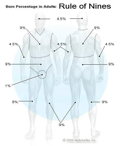 Rule of Nines diagram showing burn surface area percentages on an adult body