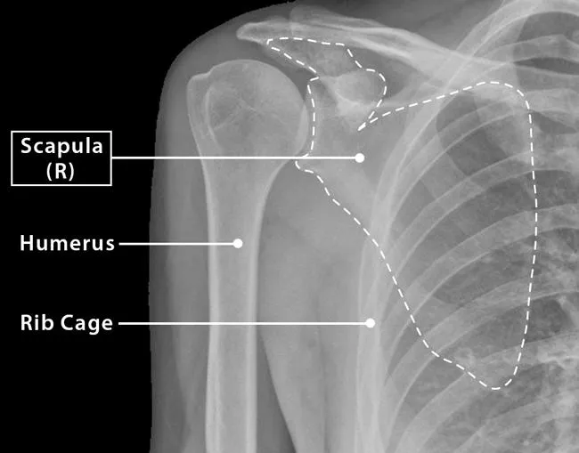 Scapula X-ray showing bone contours